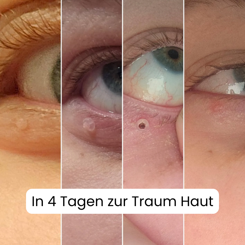 Hautpflege-Set – Entfernt Hautanhängsel sicher & effektiv, komplett Set für glatte, gepflegte Haut